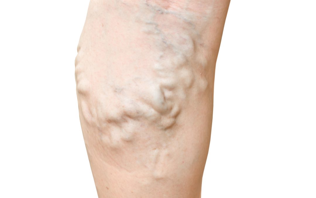 Improve Your Circulation by Consulting a Vein Specialist in Richmond, VA Today