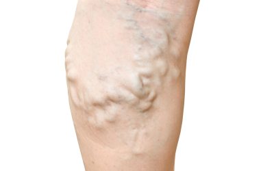 Improve Your Circulation by Consulting a Vein Specialist in Richmond, VA Today